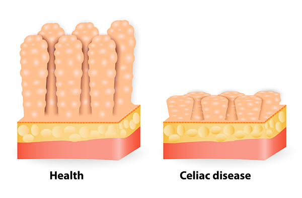 Celiachia